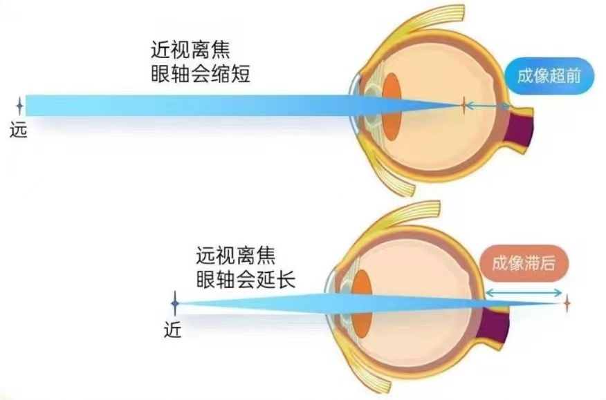 控制近视增长的方法