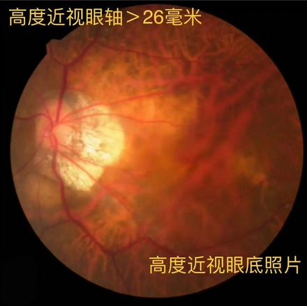 高度近视眼底照片